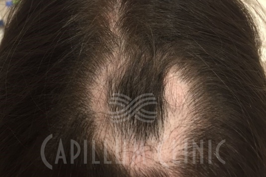 Лечение очаговой алопеции: фото до и после | Capillum Clinic