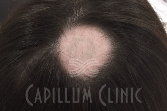 Лечение очаговой алопеции: фото до и после | Capillum Clinic